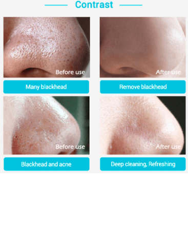 Blackhead nasal membrane with 60 sheets of blackhead tearing powerful to acne T area care